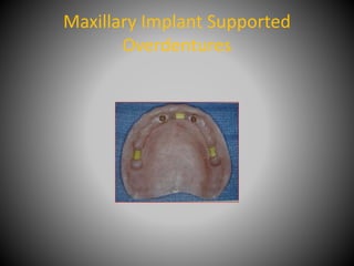 Maxillary Implant Supported
Overdentures
 