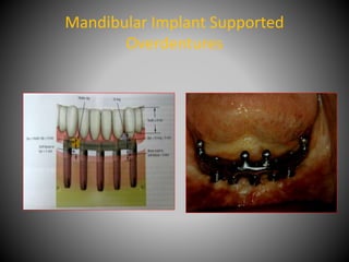 Mandibular Implant Supported
Overdentures
 