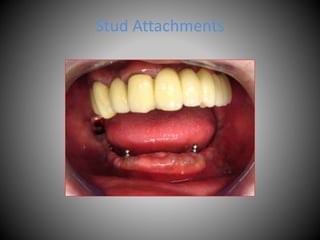 Stud Attachments
 
