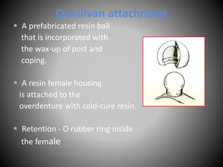 Quinlivan attachment
 A prefabricated resin ball
that is incorporated with
the wax-up of post and
coping.
 A resin female housing
is attached to the
overdenture with cold-cure resin.
 Retention - O rubber ring inside
the female
 