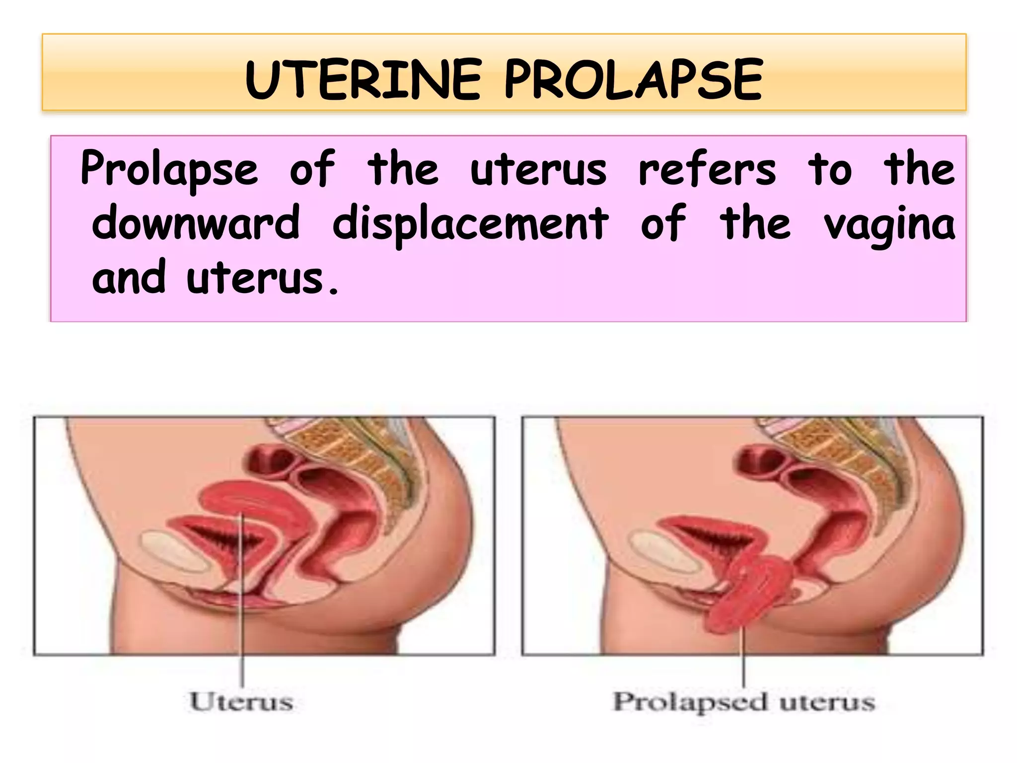 Prolapse of the uterus refers to the
downward displacement of the vagina
and uterus.
 