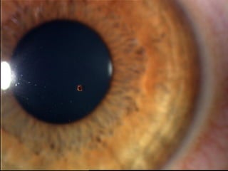 4.1 traumatismes oculars