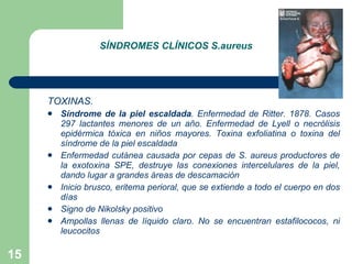 SÍNDROMES CLÍNICOS S.aureus TOXINAS. Síndrome de la piel escaldada . Enfermedad de Ritter. 1878. Casos 297 lactantes menores de un año. Enfermedad de Lyell o necrólisis epidérmica tóxica en niños mayores. Toxina exfoliatina o toxina del síndrome de la piel escaldada Enfermedad cutánea causada por cepas de S. aureus   productores de la exotoxina SPE, destruye las conexiones intercelulares de la piel, dando lugar a grandes áreas de descamación Inicio brusco, eritema perioral, que se extiende a todo el cuerpo en dos días Signo de Nikolsky positivo Ampollas llenas de líquido claro. No se encuentran estafilococos, ni leucocitos 