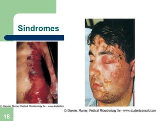 Síndromes 