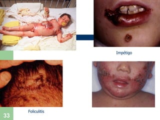 Impétigo Foliculitis 