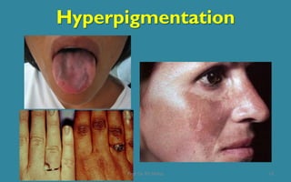 Hyperpigmentation
13Prof. Dr. RS Mehta
 