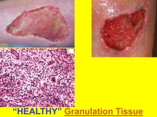 “HEALTHY” Granulation Tissue
 