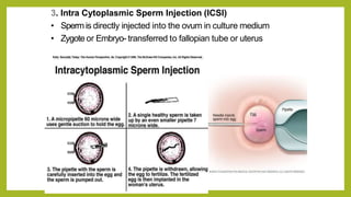 Fallopian Injection 4.reproductive health medical termination of pregnancy (mtp), | PPTX