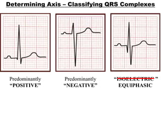 Determining Axis – Classifying QRS Complexes
Predominantly
“POSITIVE”
Predominantly
“NEGATIVE”
“ISOELECTRIC ”
EQUIPHASIC
 