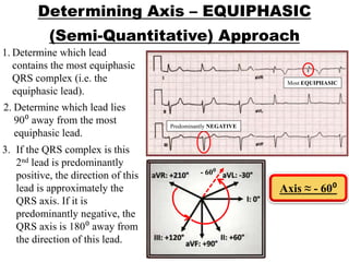 Determining Axis – EQUIPHASIC
(Semi-Quantitative) Approach
Predominantly NEGATIVE
Axis ≈ - 60⁰
Most EQUIPHASIC
- 60⁰
1. Determine which lead
contains the most equiphasic
QRS complex (i.e. the
equiphasic lead).
2. Determine which lead lies
90⁰ away from the most
equiphasic lead.
3. If the QRS complex is this
2nd lead is predominantly
positive, the direction of this
lead is approximately the
QRS axis. If it is
predominantly negative, the
QRS axis is 180⁰ away from
the direction of this lead.
 