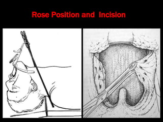 4.tonsillectomy, adenoidectomy and quinsy | PPT