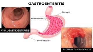 VIRAL GASTROENTERITIS
BACTERIAL GASTROENTERITIS
 