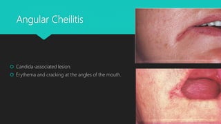 Fungal Infections of Oral Mucosa | PPTX