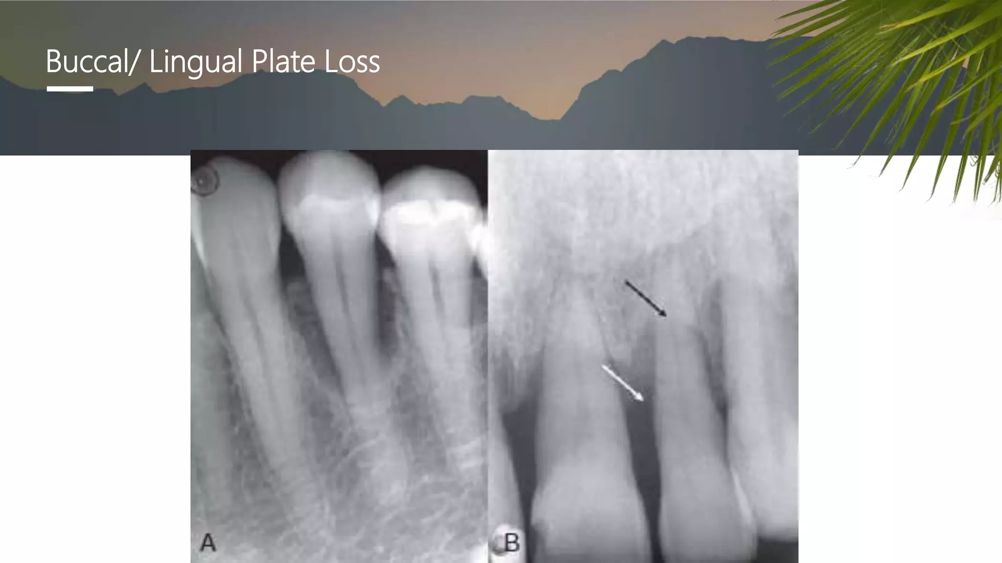 Periodontal Radiographs Radiographic Interpretation of Periodontal Diseases | PPTX