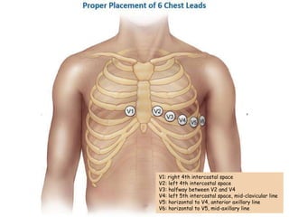 V1: right 4th intercostal space
V2: left 4th intercostal space
V3: halfway between V2 and V4
V4: left 5th intercostal space, mid-clavicular line
V5: horizontal to V4, anterior axillary line
V6: horizontal to V5, mid-axillary line
 
