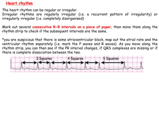 The heart rhythm can be regular or irregular.
Irregular rhythms are regularly irregular (i.e. a recurrent pattern of irregularity) or
irregularly irregular (i.e. completely disorganised)
Mark out several consecutive R-R intervals on a piece of paper, then move them along the
rhythm strip to check if the subsequent intervals are the same.
*you are suspicious that there is some atrioventricular block, map out the atrial rate and the
ventricular rhythm separately (i.e. mark the P waves and R waves). As you move along the
rhythm strip, you can then see if the PR interval changes, if QRS complexes are missing or if
there is complete dissociation between the two.
Heart rhythm
 