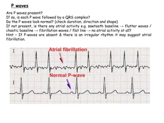 Are P waves present?
If so, is each P wave followed by a QRS complex?
Do the P waves look normal? (check duration, direction and shape)
If not present, is there any atrial activity e.g. sawtooth baseline → flutter waves /
chaotic baseline → fibrillation waves / flat line → no atrial activity at all?
Hint – If P-waves are absent & there is an irregular rhythm it may suggest atrial
fibrillation.
P waves
 