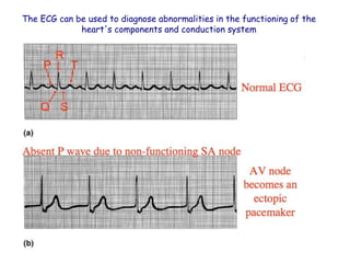 The ECG can be used to diagnose abnormalities in the functioning of the
heart's components and conduction system
 