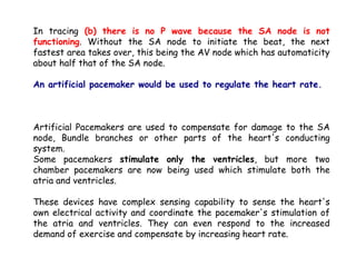 In tracing (b) there is no P wave because the SA node is not
functioning. Without the SA node to initiate the beat, the next
fastest area takes over, this being the AV node which has automaticity
about half that of the SA node.
An artificial pacemaker would be used to regulate the heart rate.
Artificial Pacemakers are used to compensate for damage to the SA
node, Bundle branches or other parts of the heart's conducting
system.
Some pacemakers stimulate only the ventricles, but more two
chamber pacemakers are now being used which stimulate both the
atria and ventricles.
These devices have complex sensing capability to sense the heart's
own electrical activity and coordinate the pacemaker's stimulation of
the atria and ventricles. They can even respond to the increased
demand of exercise and compensate by increasing heart rate.
 