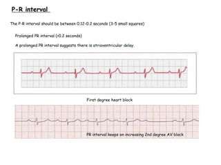 P-R interval
The P-R interval should be between 0.12-0.2 seconds (3-5 small squares)
Prolonged PR interval (>0.2 seconds)
A prolonged PR interval suggests there is atrioventricular delay.
First degree heart block
PR interval keeps on increasing 2nd degree AV block
 