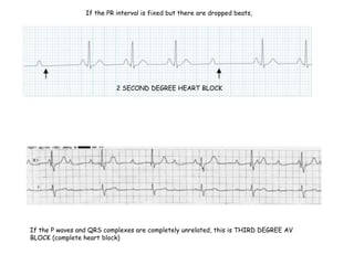 If the PR interval is fixed but there are dropped beats,
2 SECOND DEGREE HEART BLOCK
If the P waves and QRS complexes are completely unrelated, this is THIRD DEGREE AV
BLOCK (complete heart block)
 