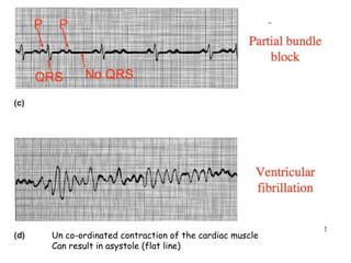 Un co-ordinated contraction of the cardiac muscle
Can result in asystole (flat line)
 