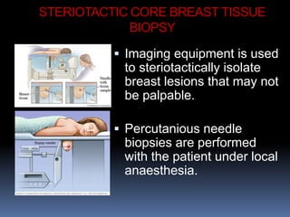 STERIOTACTIC CORE BREAST TISSUE
BIOPSY
 Imaging equipment is used
to steriotactically isolate
breast lesions that may not
be palpable.
 Percutanious needle
biopsies are performed
with the patient under local
anaesthesia.
 