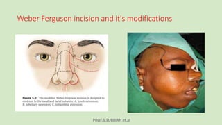 PROF.S.SUBBIAH et.al
Weber Ferguson incision and it's modifications
 