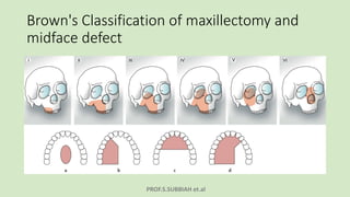PROF.S.SUBBIAH et.al
Brown's Classification of maxillectomy and
midface defect
 