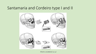 PROF.S.SUBBIAH et.al
Santamaria and Cordeiro type I and II
 