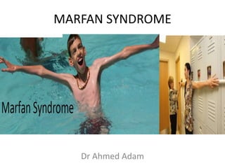 MARFAN SYNDROME
Dr Ahmed Adam
 