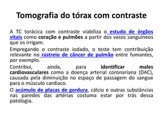 Tomografia do tórax com contraste
A TC torácica com contraste viabiliza o estudo de órgãos
vitais como coração e pulmões a partir dos vasos sanguíneos
que os irrigam.
Empregando o contraste iodado, o teste tem contribuição
relevante no rastreio de câncer de pulmão entre fumantes,
por exemplo.
Contribui, ainda, para identificar males
cardiovasculares como a doença arterial coronariana (DAC),
causada pela diminuição no espaço de passagem do sangue
para o músculo cardíaco.
O acúmulo de placas de gordura, cálcio e outras substâncias
nas paredes das artérias costuma estar por trás dessa
patologia.
 