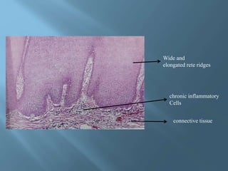 Tissue Ridges 4.NON-ODONTOGENIC TUMOURS OF EPITHELIAL TISSUE ORIGIN.pptx