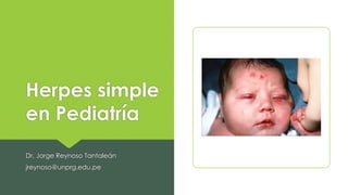 Herpes simple
en Pediatría
Dr. Jorge Reynoso Tantaleán
jreynoso@unprg.edu.pe
 