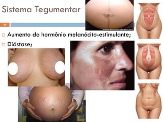 Sistema Tegumentar
 Aumento do hormônio melanócito-estimulante;
 Diástase;
30
 