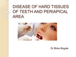 DISEASE OF HARD TISSUES
OF TEETH AND PERIAPICAL
AREA
Dr Birke Bogale
 