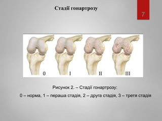 4-Ендопротез колінного суглобу.ppt