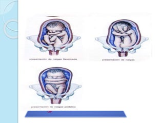 Variedad de posición fetal. Es la
relacion de una porción arbitrariamente
elegida de la presentación con respecto
al lado derecho o izquierdo del conducto
de parto.
Con cada presentación puede haber dos
variedades de posición: derecha e
izquierda.
El Occipucio, mentón, sacro son los
puntos elegidos respectivamente para
las presentaciones vértice, cara y
pélvica
 
