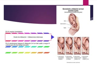 EU ingreso hospitalario
Grado de dilatación + dilataciones dolorosas
Px membranas integras dilatación 3-4 cm del cuello o mayor
umbral para Dx de trabajo de parto
 