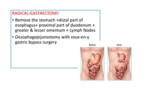 RADICAL GASTRECTOMY
• Remove the stomach +distal part of
esophagus+ proximal part of duodenum +
greater & lesser omentum + Lymph Nodes
• Oesophagojejunostomy with roux-en-y
gastric bypass surgery
 