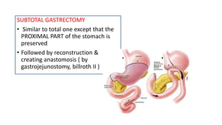 SUBTOTAL GASTRECTOMY
• Similar to total one except that the
PROXIMAL PART of the stomach is
preserved
• Followed by reconstruction &
creating anastomosis ( by
gastrojejunostomy, billroth II )
 