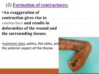 (2) Formation of contractures:
•An exaggeration of
contraction gives rise to
contracture and results in
deformities of the wound and
the surrounding tissues.
•common sites: palms, the soles, and
the anterior aspect of the thorax
 