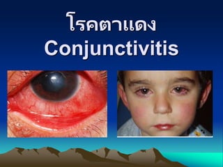 โรคตาแดง
Conjunctivitis
 