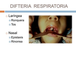 DIFTERIA RESPIRATORIA
 Laríngea
 Ronquera
 Tos
 Nasal
 Epistaxis
 Rinorrea
 