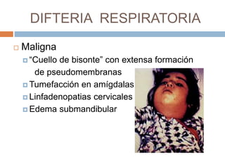 DIFTERIA RESPIRATORIA
 Maligna
 “Cuello de bisonte” con extensa formación
de pseudomembranas
 Tumefacción en amígdalas
 Linfadenopatias cervicales
 Edema submandibular
 