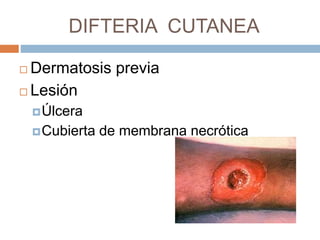 DIFTERIA CUTANEA
 Dermatosis previa
 Lesión
Úlcera
Cubierta de membrana necrótica
 