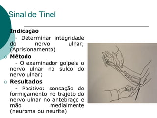 Sinal de Tinel
 Indicação
- Determinar integridade
do nervo ulnar;
(Aprisionamento)
 Método
- O examinador golpeia o
nervo ulnar no sulco do
nervo ulnar;
 Resultados
- Positivo: sensação de
formigamento no trajeto do
nervo ulnar no antebraço e
mão medialmente
(neuroma ou neurite)
 