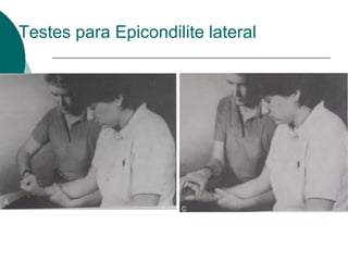 Testes para Epicondilite lateral
 