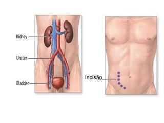 Incisão
 