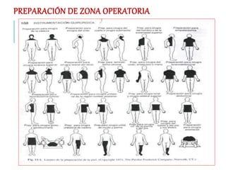 PREPARACIÓN DE ZONA OPERATORIA
 